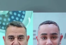 Veja Vídeo – Turco de 58 anos viraliza após passar por procedimento de rejuvenescimento no Vietnã