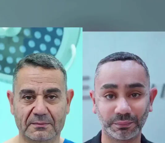 Veja Vídeo – Turco de 58 anos viraliza após passar por procedimento de rejuvenescimento no Vietnã